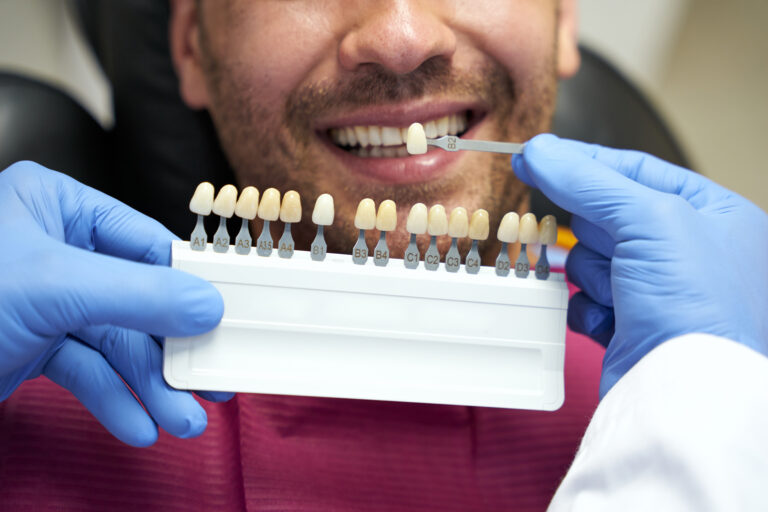 Cropped photo of bearded man smiling while dental specialist picking proper shade of enamel